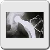 X RAY HIP JOINT REPLACEMENT